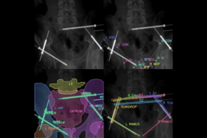 Fou X-ray images of pelvic surgical procedure